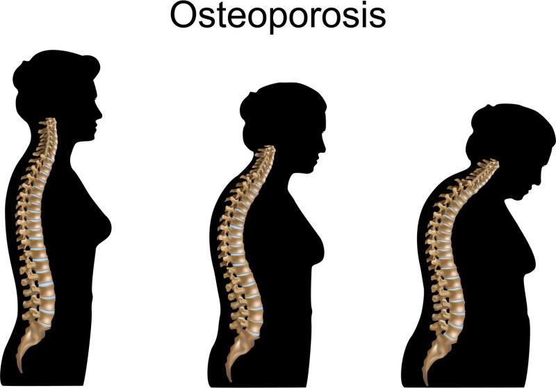 Kesan Osteoporosis